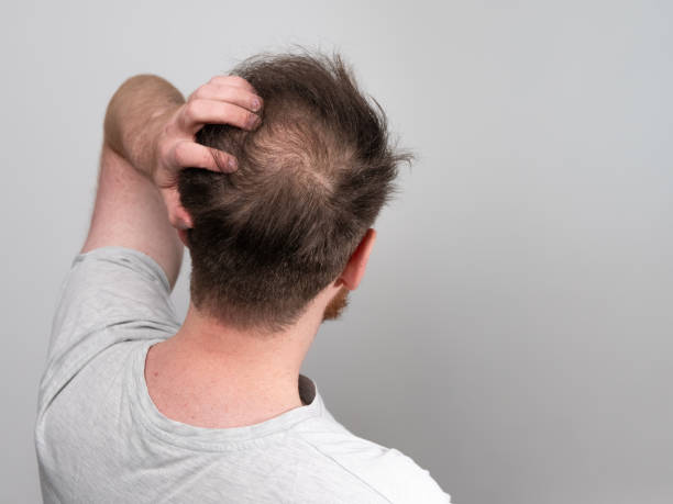 alopecie