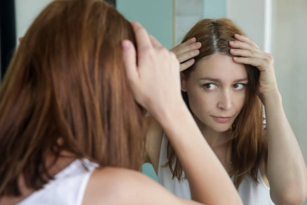 chute de cheveux femme 1
